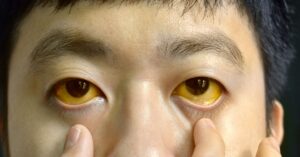 yellow eyes, pediatric care in indore