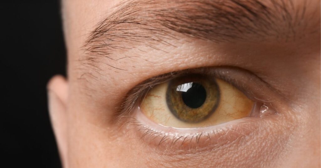 नवजात में पीलिया, pediatric care in indore